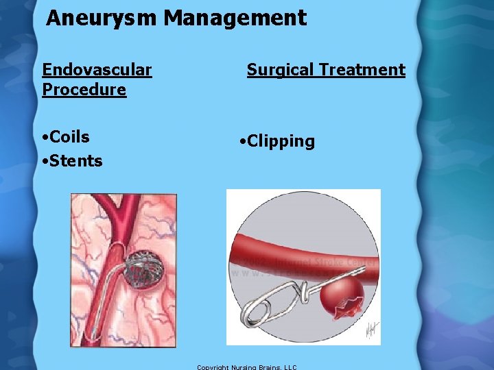 Aneurysm Management Endovascular Procedure • Coils • Stents Surgical Treatment • Clipping 