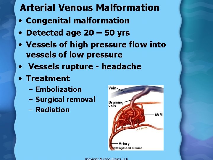 Arterial Venous Malformation • Congenital malformation • Detected age 20 – 50 yrs •
