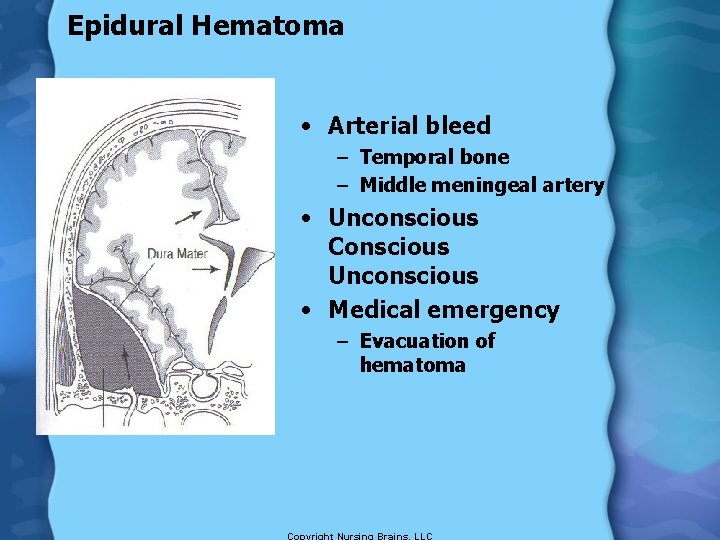 Epidural Hematoma • Arterial bleed – Temporal bone – Middle meningeal artery • Unconscious