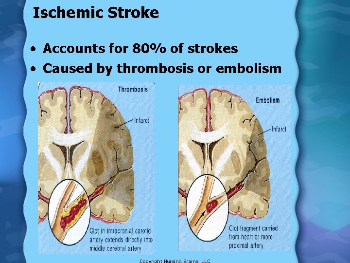 Ischemic Stroke • Accounts for 80% of strokes • Caused by thrombosis or embolism