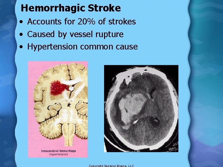 Hemorrhagic Stroke • Accounts for 20% of strokes • Caused by vessel rupture •