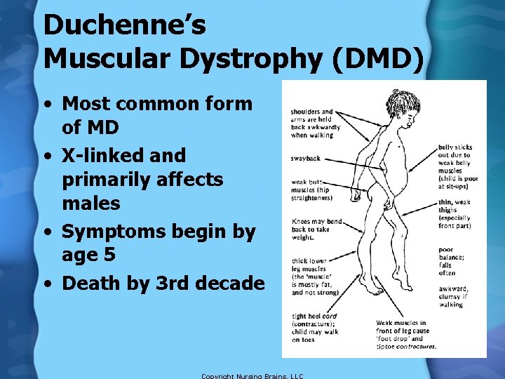 Duchenne’s Muscular Dystrophy (DMD) • Most common form of MD • X-linked and primarily