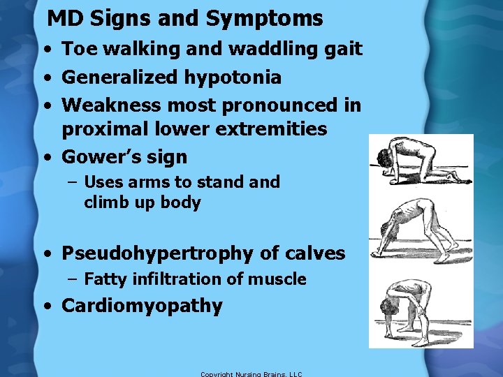 MD Signs and Symptoms • Toe walking and waddling gait • Generalized hypotonia •