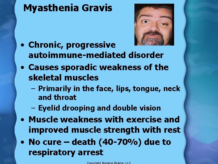 Myasthenia Gravis • Chronic, progressive autoimmune-mediated disorder • Causes sporadic weakness of the skeletal