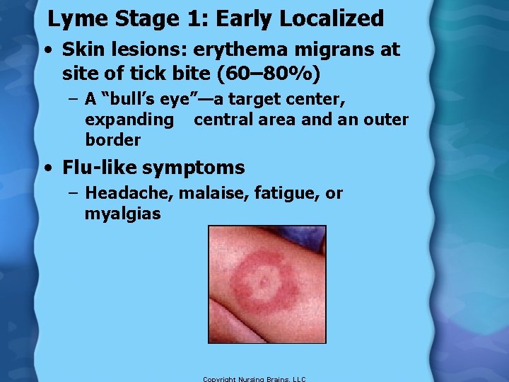 Lyme Stage 1: Early Localized • Skin lesions: erythema migrans at site of tick
