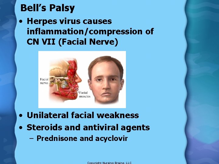 Bell’s Palsy • Herpes virus causes inflammation/compression of CN VII (Facial Nerve) • Unilateral