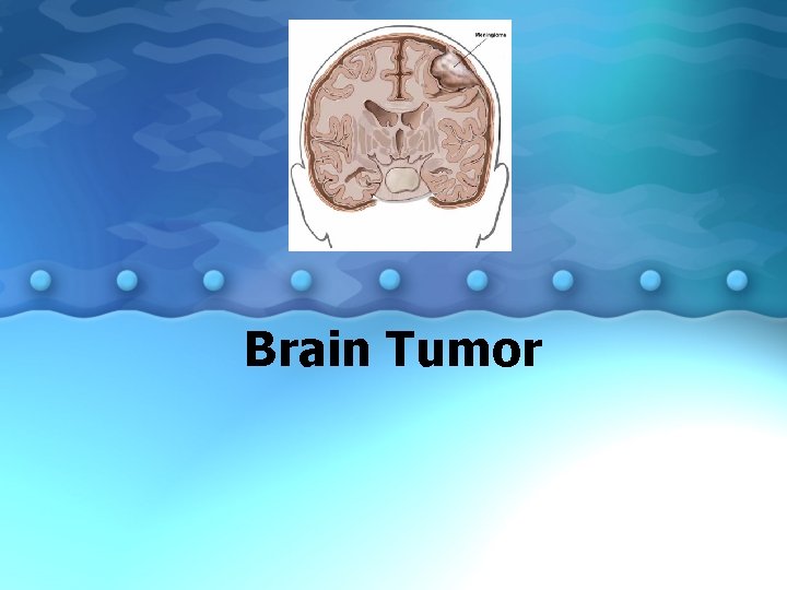 Brain Tumor 