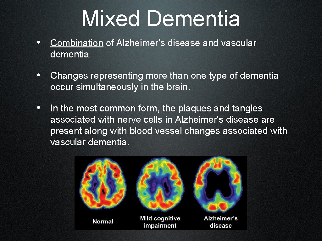 Mixed Dementia • Combination of Alzheimer’s disease and vascular dementia • Changes representing more