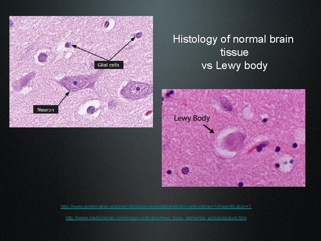 Histology of normal brain tissue vs Lewy body http: //www. proteinatlas. org/learn/dictionary/normal/cerebral+cortex/detail+1/magnification+1 http: //www.