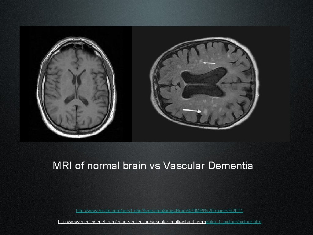 MRI of normal brain vs Vascular Dementia http: //www. mr-tip. com/serv 1. php? type=img&img=Brain%20
