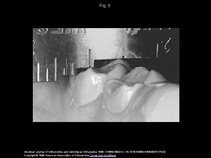 Fig. 9 American Journal of Orthodontics and Dentofacial Orthopedics 1998 114589 -599 DOI: (10.