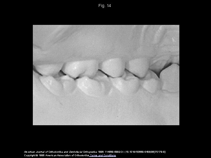 Fig. 14 American Journal of Orthodontics and Dentofacial Orthopedics 1998 114589 -599 DOI: (10.