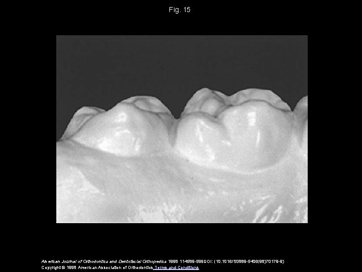 Fig. 15 American Journal of Orthodontics and Dentofacial Orthopedics 1998 114589 -599 DOI: (10.