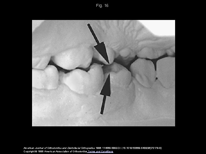 Fig. 16 American Journal of Orthodontics and Dentofacial Orthopedics 1998 114589 -599 DOI: (10.