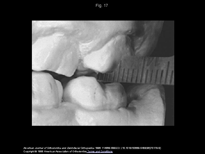 Fig. 17 American Journal of Orthodontics and Dentofacial Orthopedics 1998 114589 -599 DOI: (10.