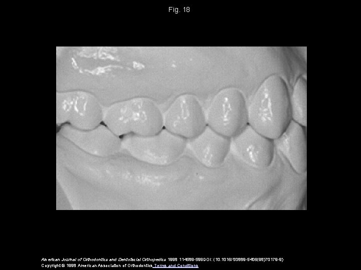 Fig. 18 American Journal of Orthodontics and Dentofacial Orthopedics 1998 114589 -599 DOI: (10.