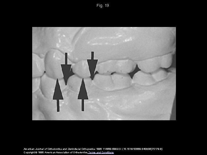 Fig. 19 American Journal of Orthodontics and Dentofacial Orthopedics 1998 114589 -599 DOI: (10.