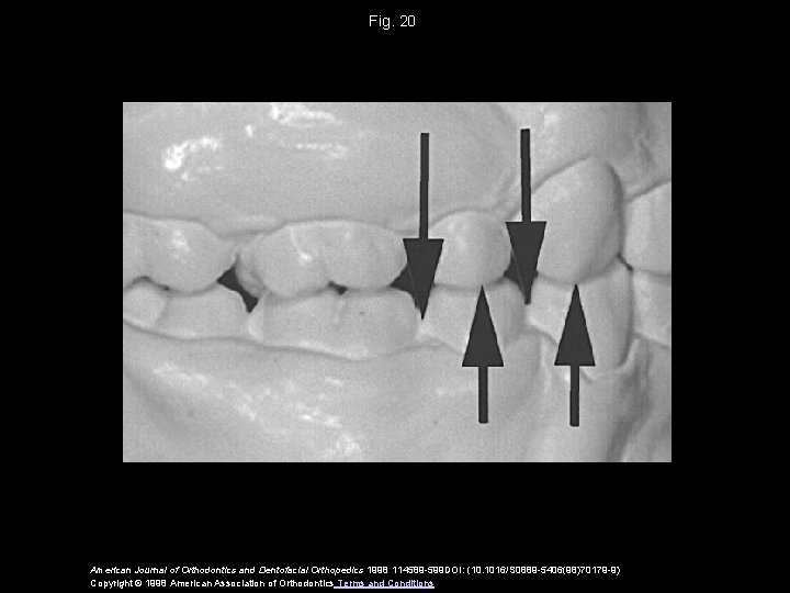 Fig. 20 American Journal of Orthodontics and Dentofacial Orthopedics 1998 114589 -599 DOI: (10.