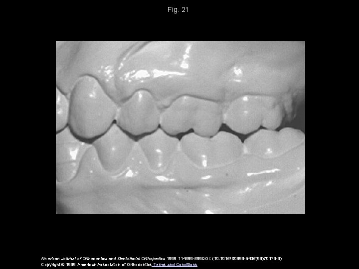 Fig. 21 American Journal of Orthodontics and Dentofacial Orthopedics 1998 114589 -599 DOI: (10.