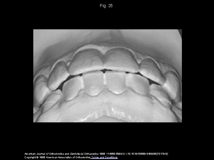 Fig. 25 American Journal of Orthodontics and Dentofacial Orthopedics 1998 114589 -599 DOI: (10.
