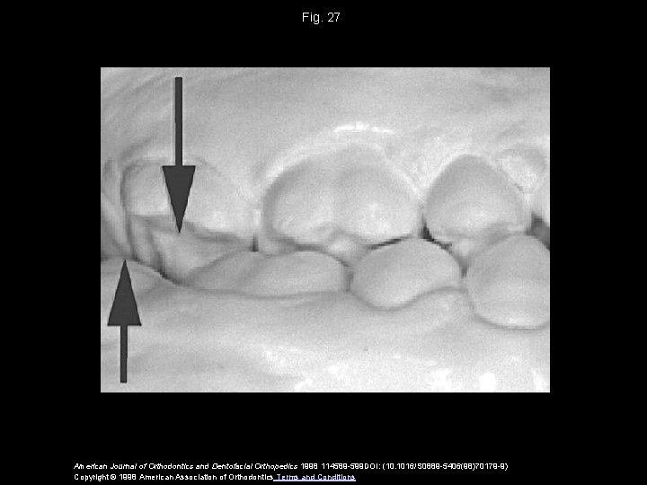 Fig. 27 American Journal of Orthodontics and Dentofacial Orthopedics 1998 114589 -599 DOI: (10.