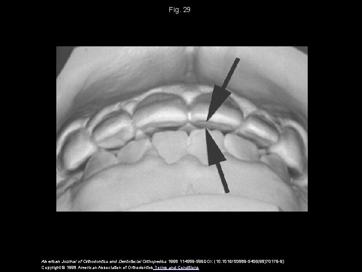 Fig. 29 American Journal of Orthodontics and Dentofacial Orthopedics 1998 114589 -599 DOI: (10.