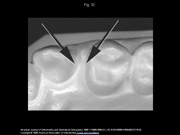 Fig. 32 American Journal of Orthodontics and Dentofacial Orthopedics 1998 114589 -599 DOI: (10.