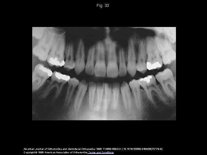 Fig. 33 American Journal of Orthodontics and Dentofacial Orthopedics 1998 114589 -599 DOI: (10.