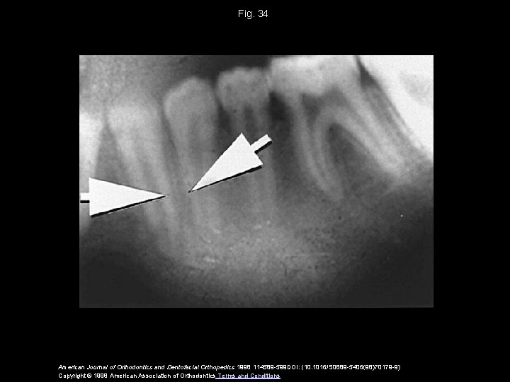 Fig. 34 American Journal of Orthodontics and Dentofacial Orthopedics 1998 114589 -599 DOI: (10.