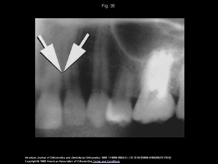 Fig. 35 American Journal of Orthodontics and Dentofacial Orthopedics 1998 114589 -599 DOI: (10.