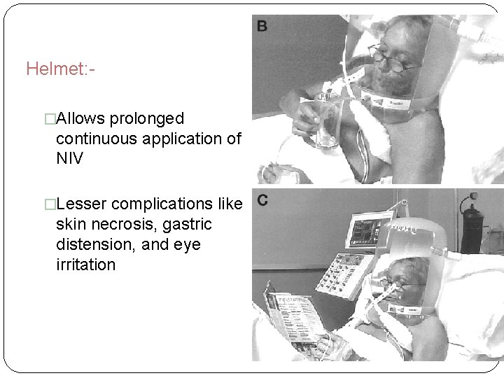 Helmet: �Allows prolonged continuous application of NIV �Lesser complications like skin necrosis, gastric distension,