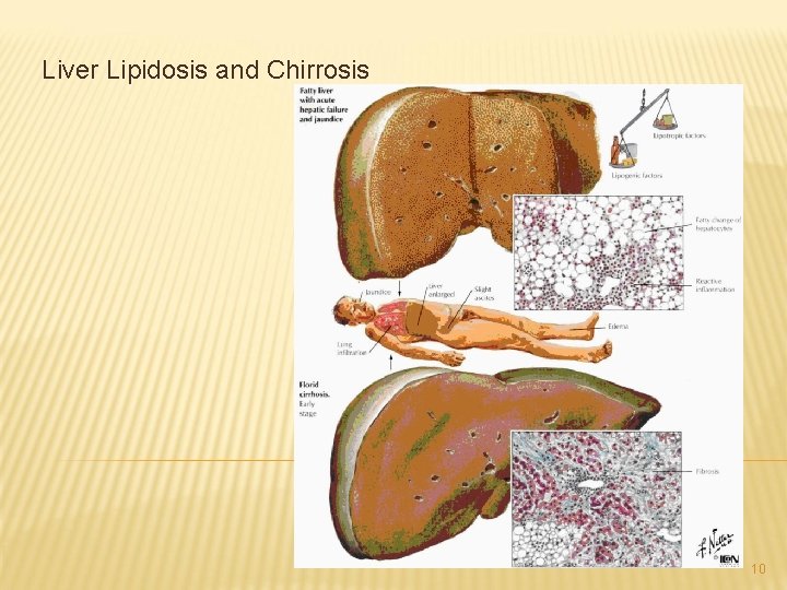 Liver Lipidosis and Chirrosis 10 