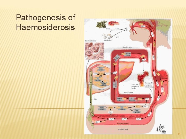 Pathogenesis of Haemosiderosis 11 
