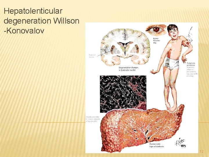 Hepatolenticular degeneration Willson -Konovalov 12 