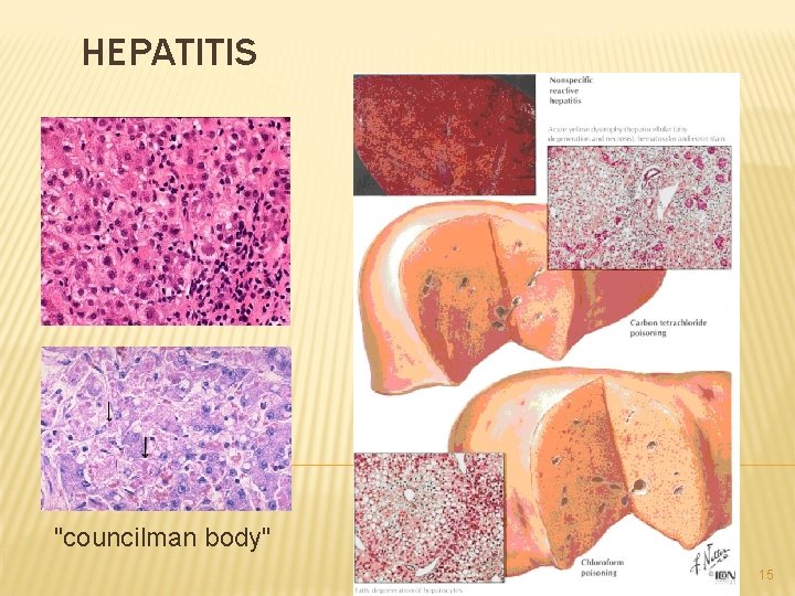 HEPATITIS "councilman body" 15 