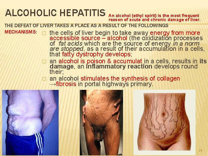 ALCOHOLIC HEPATITIS An alcohol (ethyl spirit) is the most frequent reason of acute and
