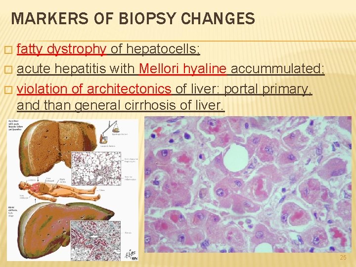 MARKERS OF BIOPSY CHANGES fatty dystrophy of hepatocells; � acute hepatitis with Mellori hyaline