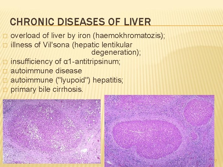 CHRONIC DISEASES OF LIVER � � � overload of liver by iron (haemokhromatozis); illness