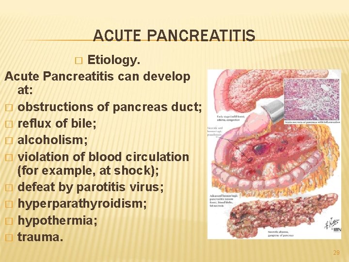 ACUTE PANCREATITIS Etiology. Acute Pancreatitis can develop at: � obstructions of pancreas duct; �