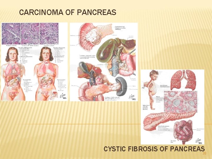 CARCINOMA OF PANCREAS CYSTIC FIBROSIS OF PANCREAS 38 