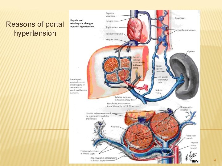 Reasons of portal hypertension 4 