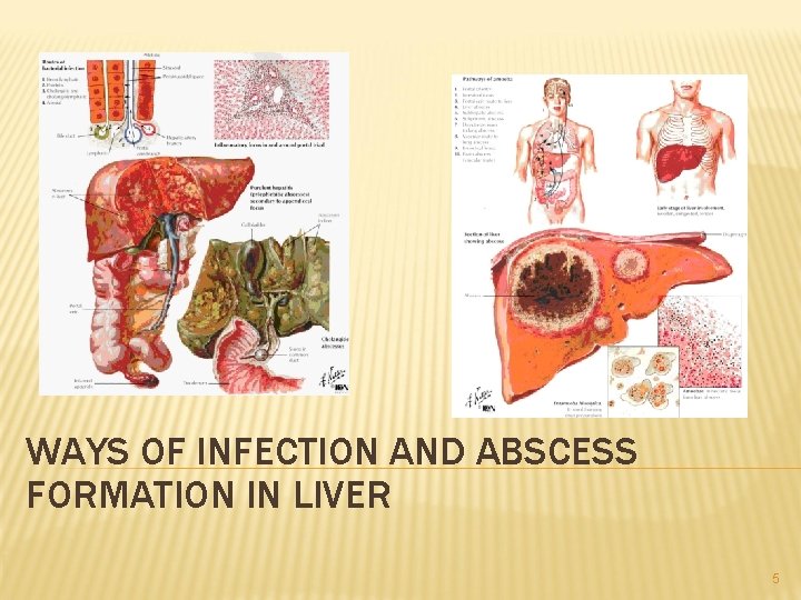 WAYS OF INFECTION AND ABSCESS FORMATION IN LIVER 5 