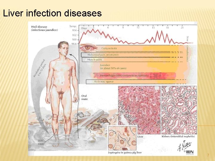 Liver infection diseases 7 