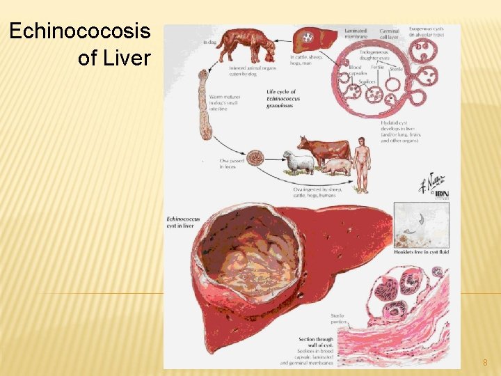 Echinococosis of Liver 8 