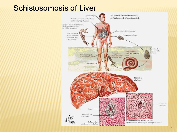 Schistosomosis of Liver 9 