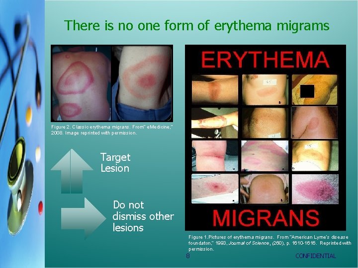 There is no one form of erythema migrams Figure 2. Classic erythema migrans. From”