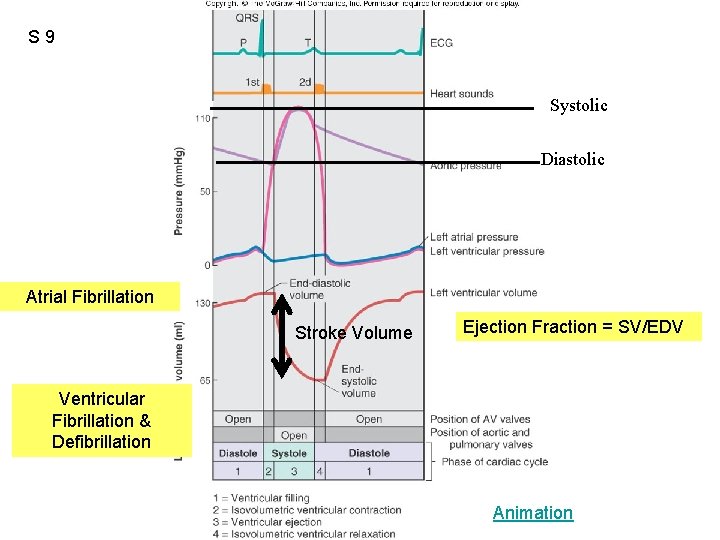 S 9 Figure 12. 20 Systolic Diastolic Atrial Fibrillation Stroke Volume Ejection Fraction =