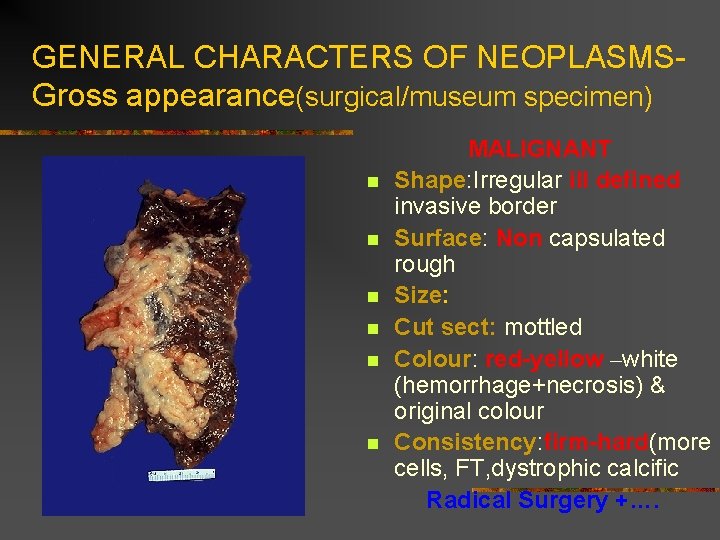 GENERAL CHARACTERS OF NEOPLASMSGross appearance(surgical/museum specimen) n n n MALIGNANT Shape: Irregular ill defined