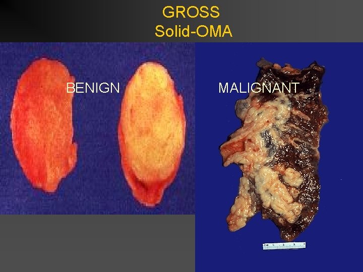 GROSS Solid-OMA BENIGN MALIGNANT 