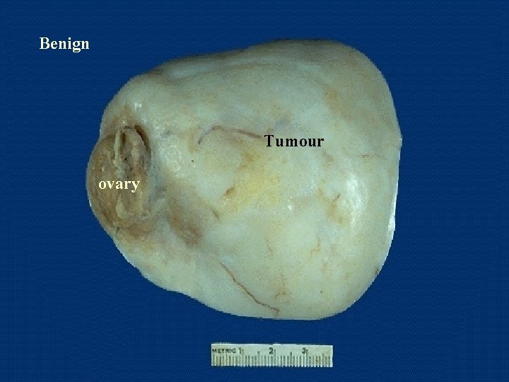 Benign Tumour ovary 